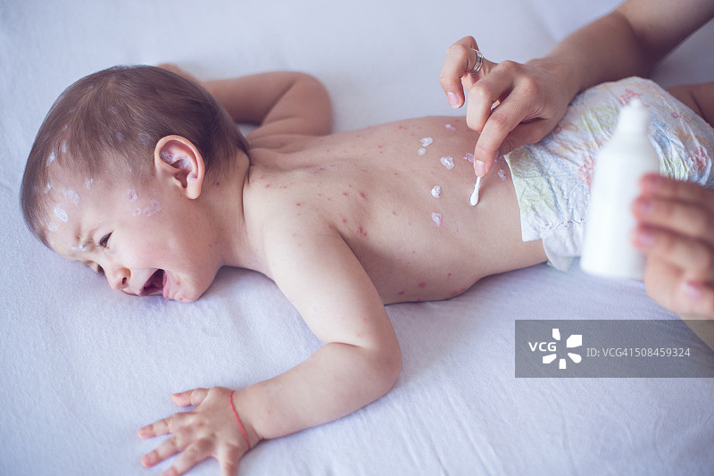 母亲照顾患有水痘的婴儿图片素材