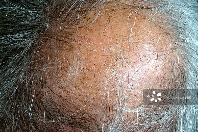 男性秃顶图片素材