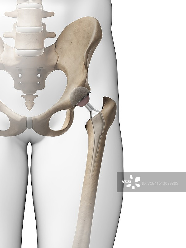 人体髋关节置换术，艺术作品图片素材