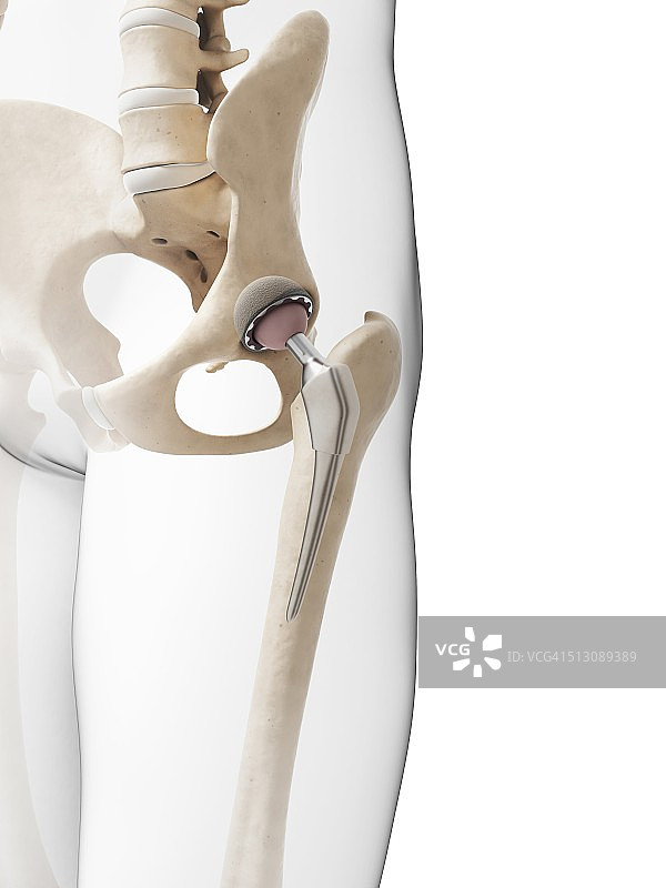 人体髋关节置换术，艺术作品图片素材