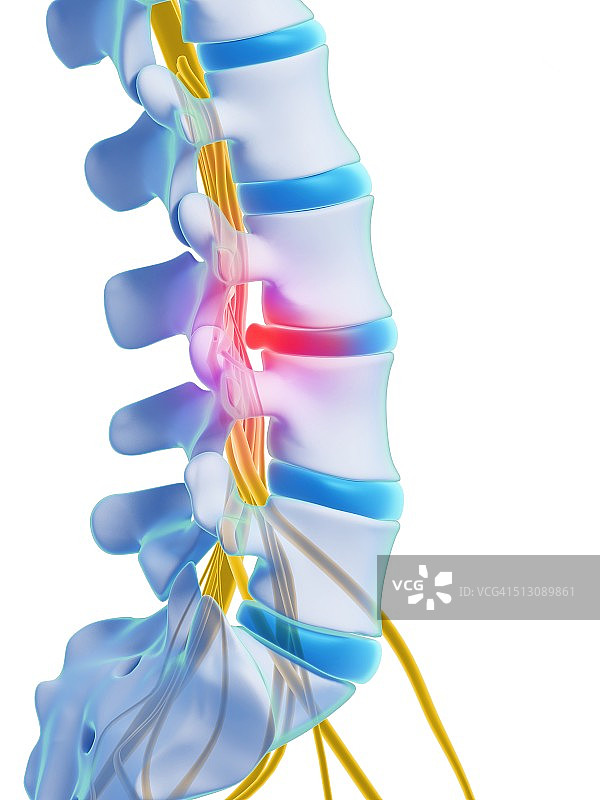 椎间盘滑脱艺术作品图片素材