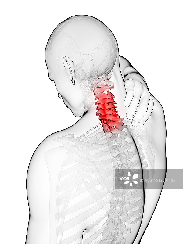 人类颈部疼痛示意图图片素材