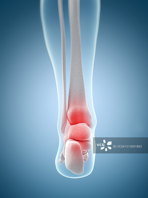 人类脚踝疼痛艺术图图片素材