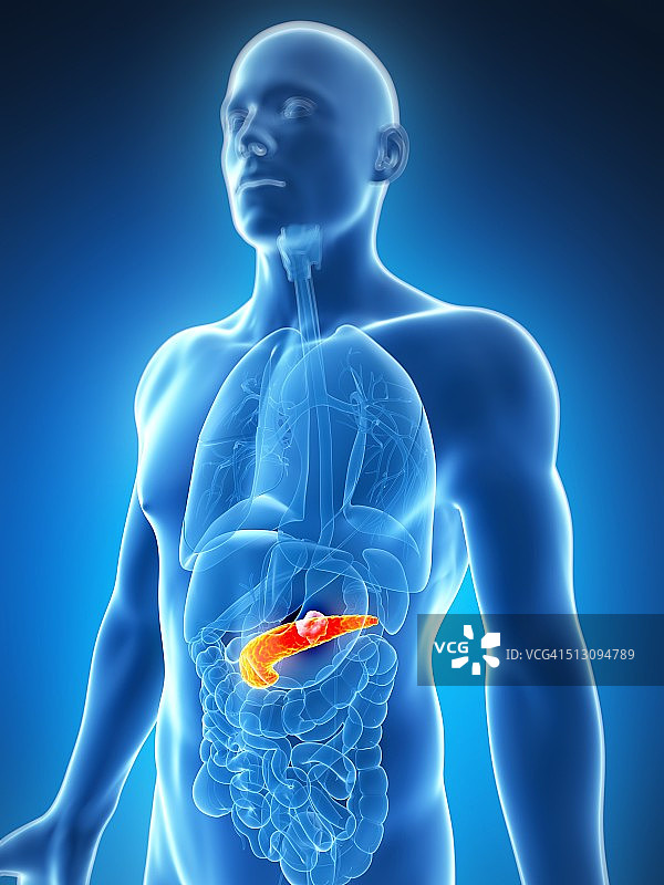 显示肿瘤的人体胰腺，艺术作品图片素材