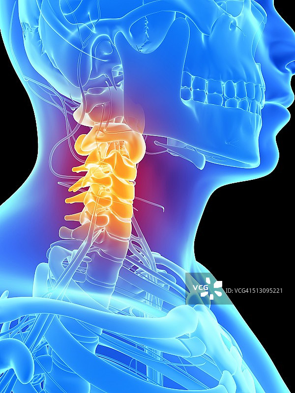 人类颈部疼痛示意图图片素材