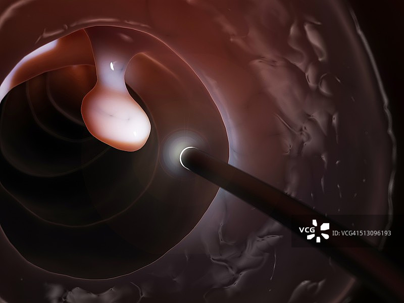 结肠镜检查中发现的息肉，艺术作品图片素材