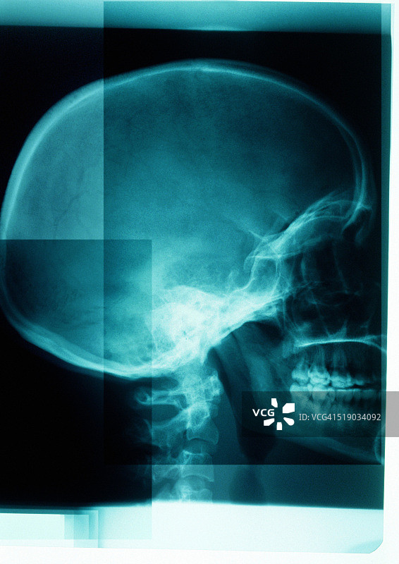 头骨X光片图片素材