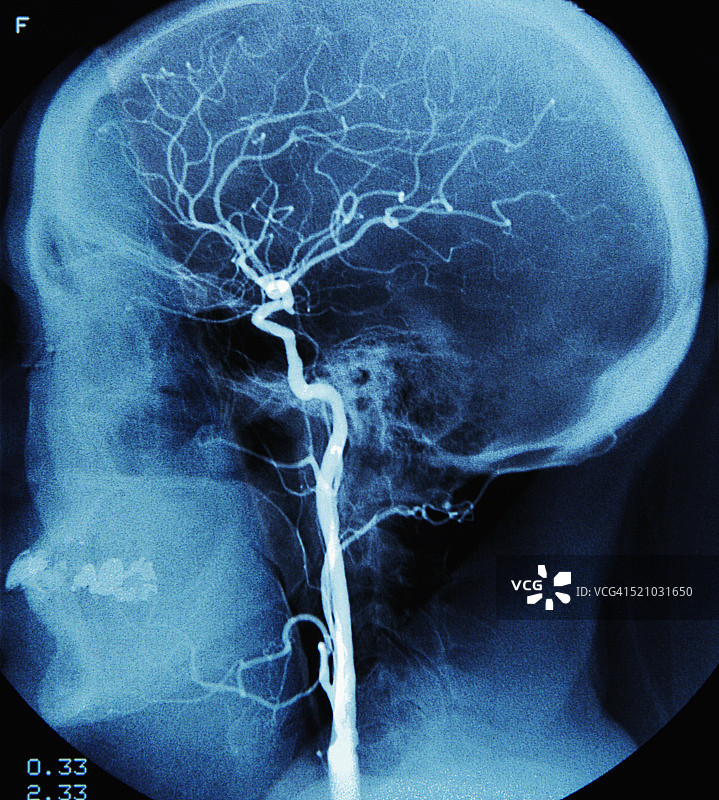 人头部的X光片图片素材