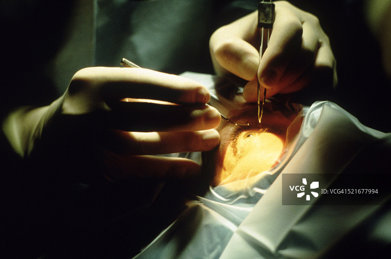 眼科手术图片素材