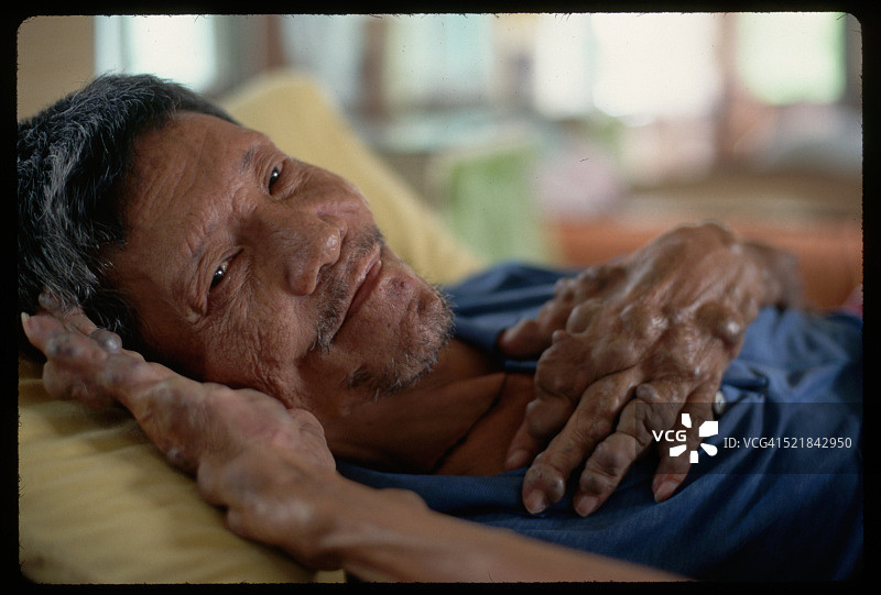 菲律宾疗养院的麻风病患者图片素材