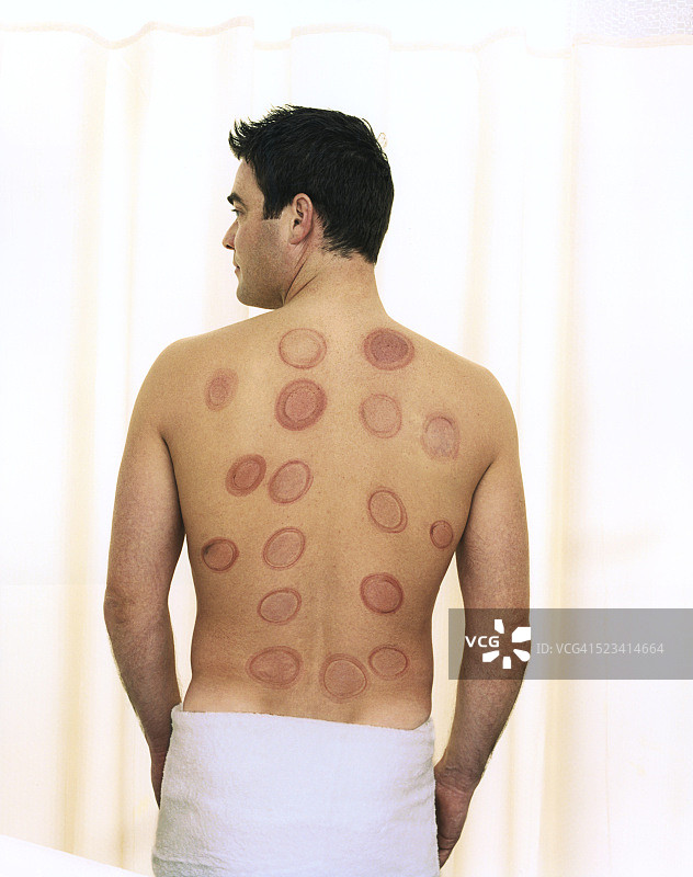 背上有拔罐印记的男人图片素材