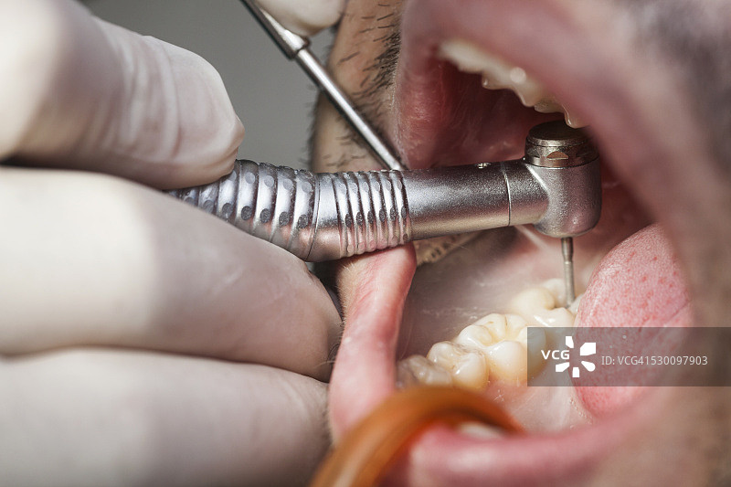 牙齿优化图片素材