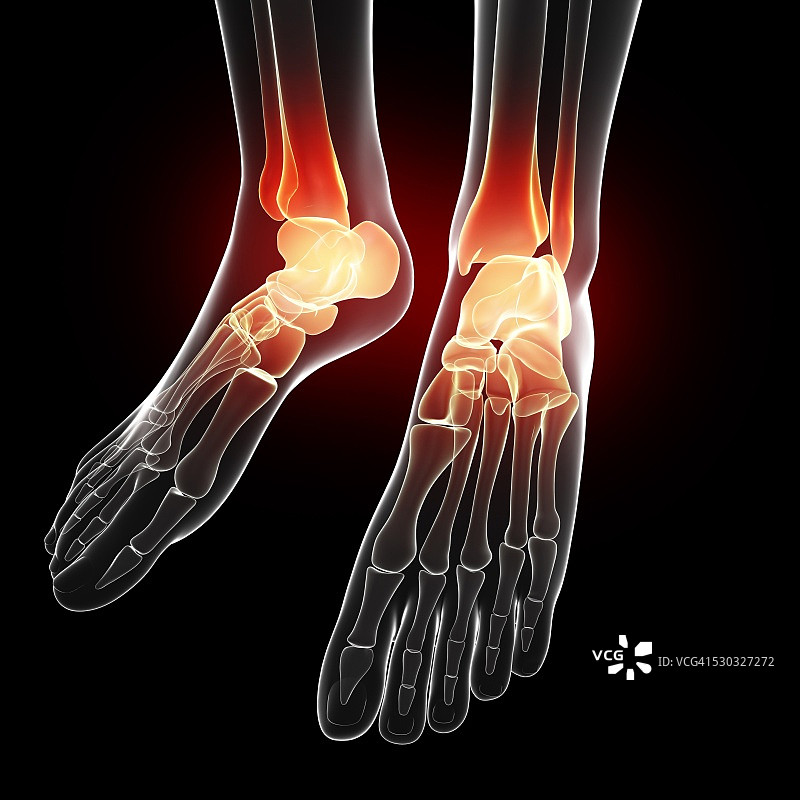 脚部疼痛（电脑绘画）图片素材