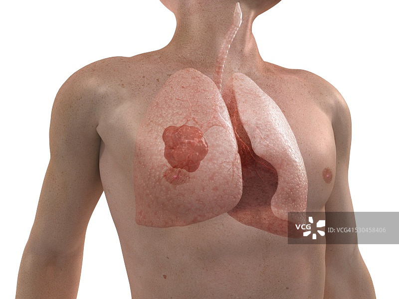 肺癌艺术作品图片素材