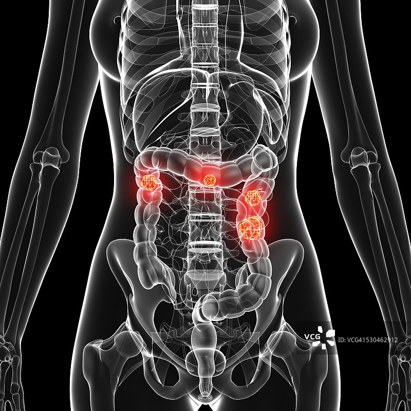 结肠癌计算机图图片素材