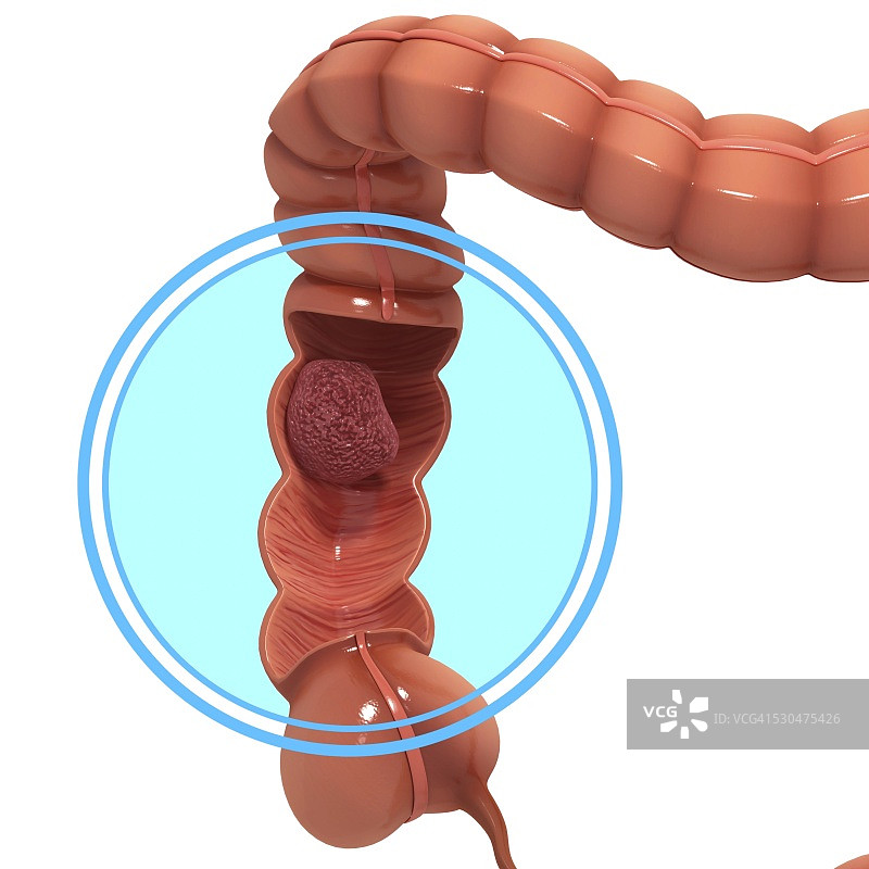 结肠癌计算机图图片素材