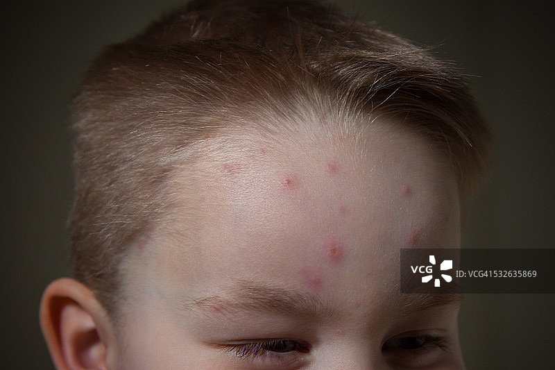 男孩额头上的水痘图片素材