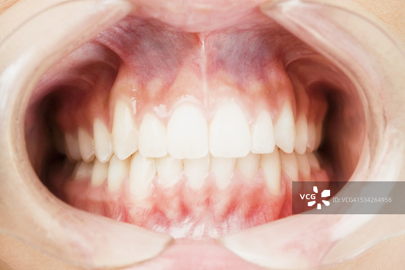 使用开口器的患者图片素材