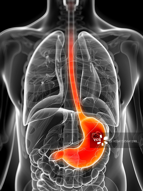 人类胃癌图示图片素材