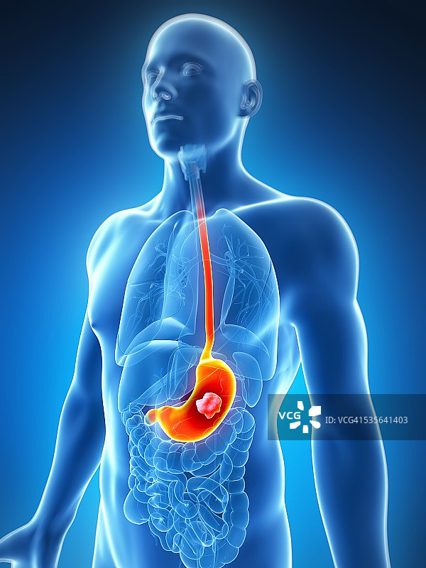 人体胃溃疡插图图片素材