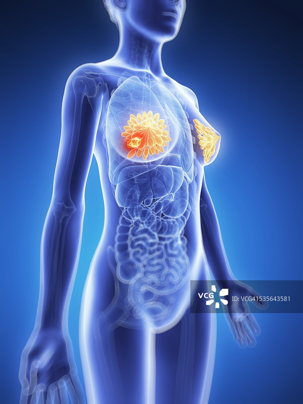 人类乳腺癌图示图片素材