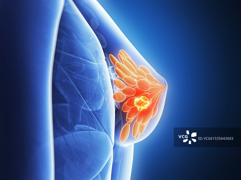 人类乳腺癌图示图片素材
