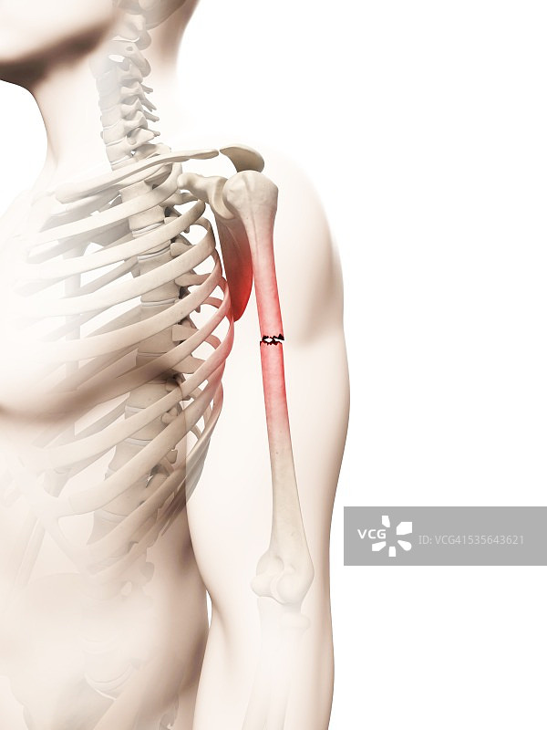 手臂骨折插画图片素材
