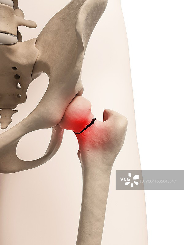 髋骨骨折插画图片素材