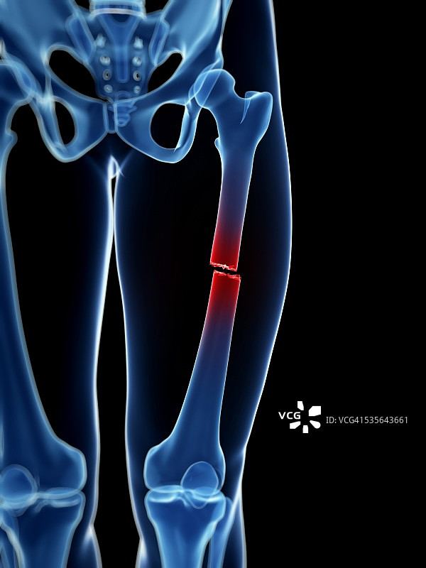 破损的股骨插图图片素材