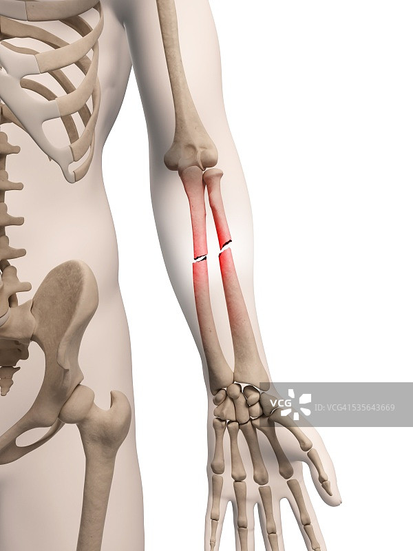 骨折手臂骨骼图图片素材