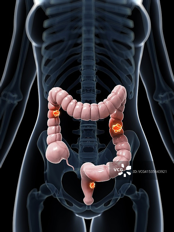 人类结肠癌示意图图片素材