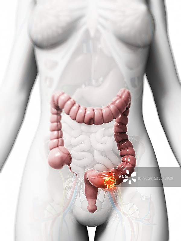 人类结肠癌示意图图片素材