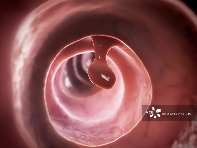 人类结肠息肉插图图片素材