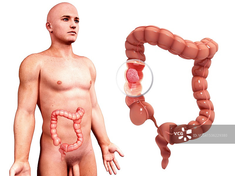 肠癌计算机艺术图图片素材