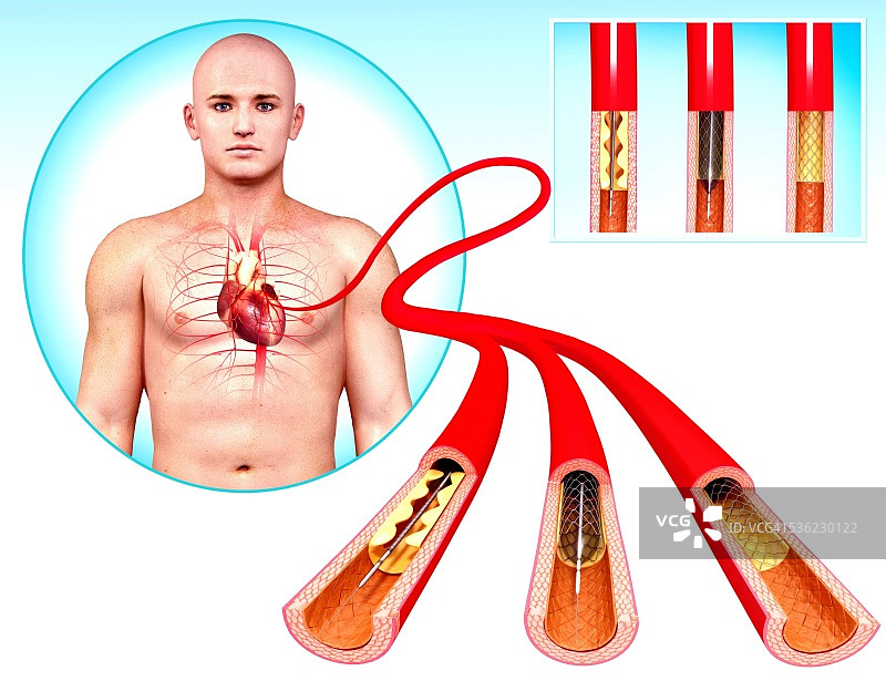 血管成形术，电脑绘图图片素材