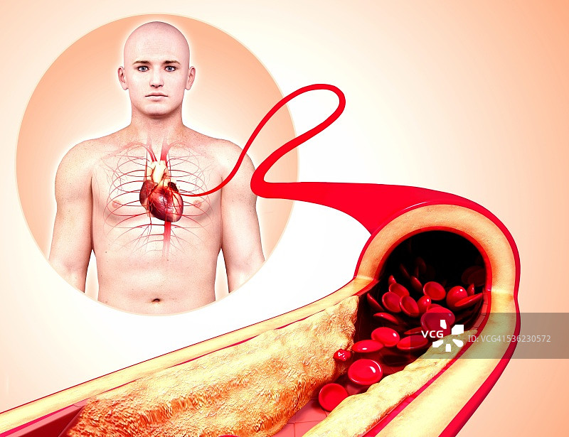 动脉粥样硬化电脑绘图图片素材