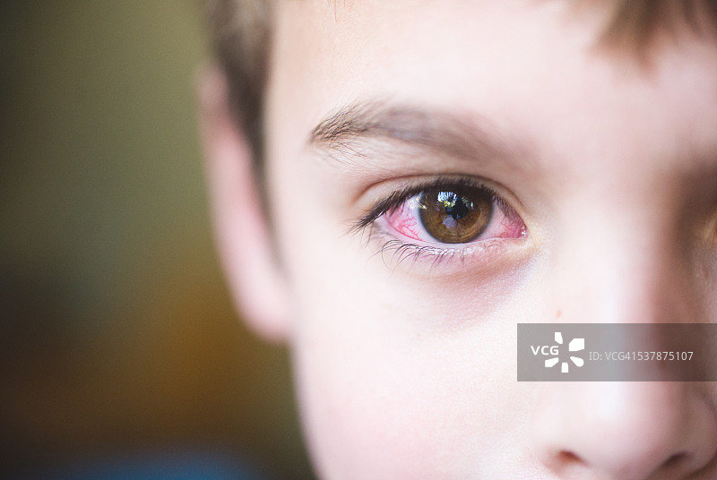患有结膜炎或红眼病的男孩图片素材