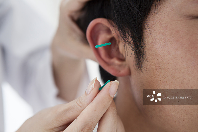 男人接受耳部针灸治疗图片素材