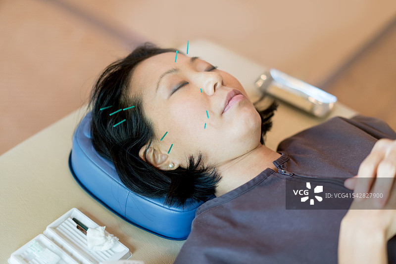 成年女性接受针灸图片素材