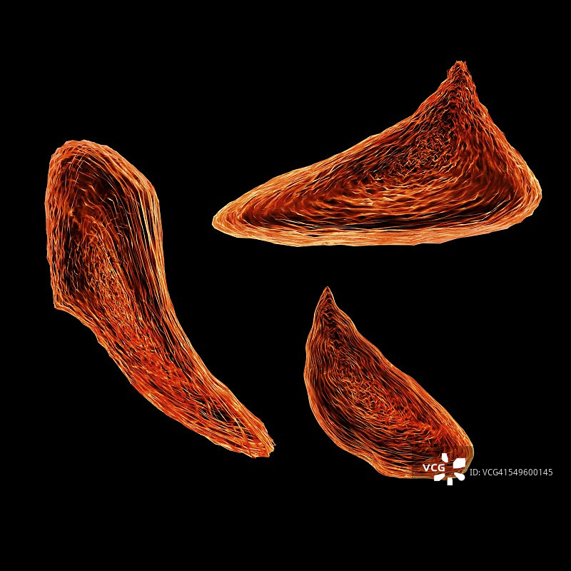 镰状细胞贫血症插图图片素材