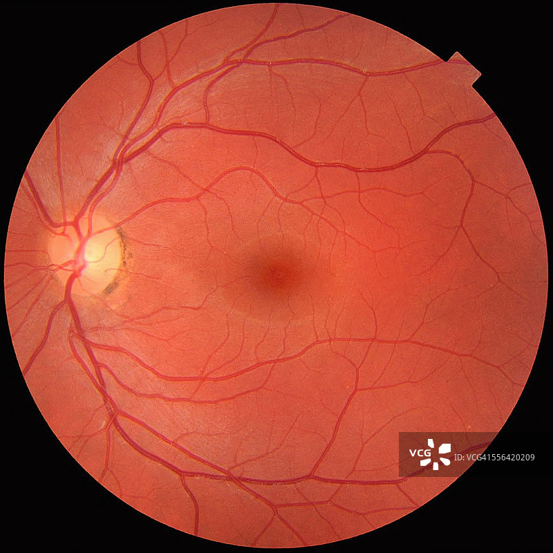 正常左眼眼底照片：中央为黄斑，血管在周边色素沉着处汇聚形成视盘图片素材