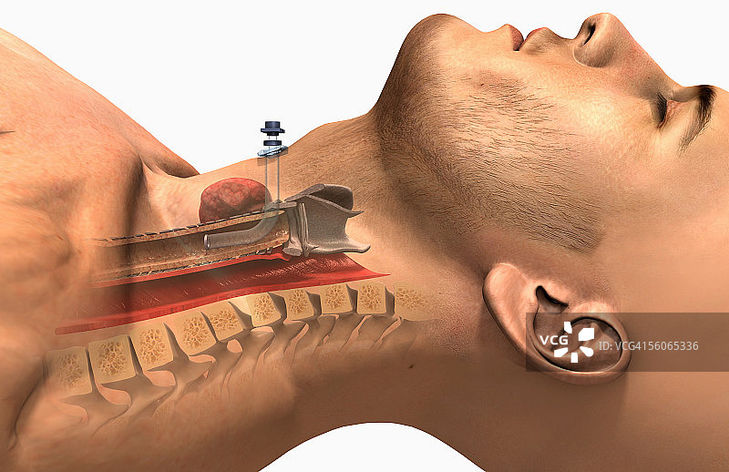 气管切开术的侧视图。图片素材