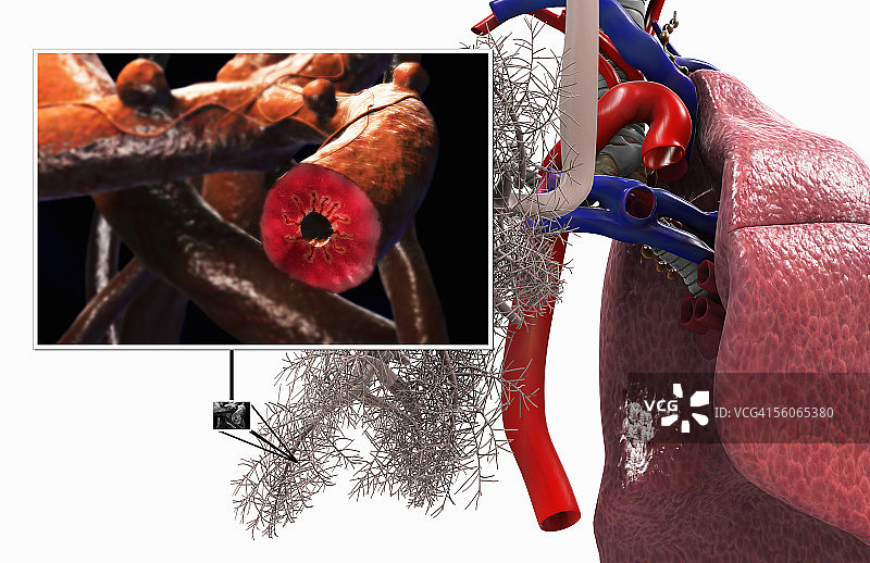 哮喘性细支气管的一部分图片素材