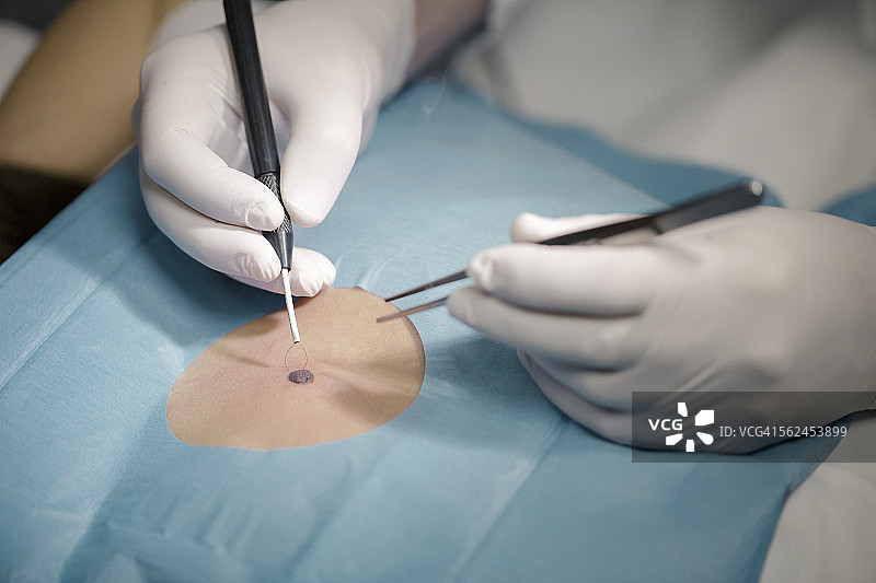 皮肤科医生去除痣，特写图片素材