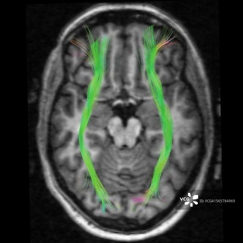 连接额叶和枕叶（视觉）的额枕连接俯视图图片素材