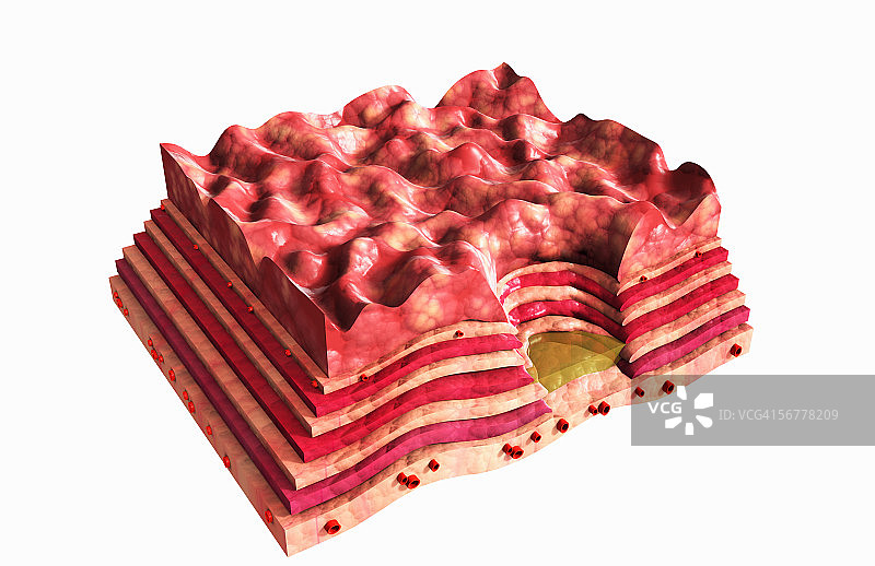 慢性胃溃疡图示图片素材