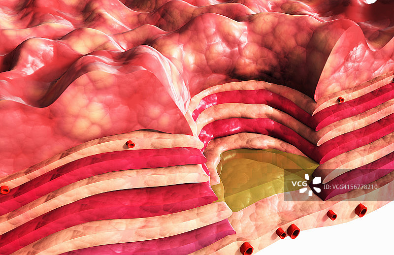 慢性胃溃疡图示图片素材