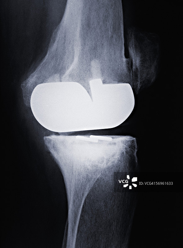 假体膝关节图片素材