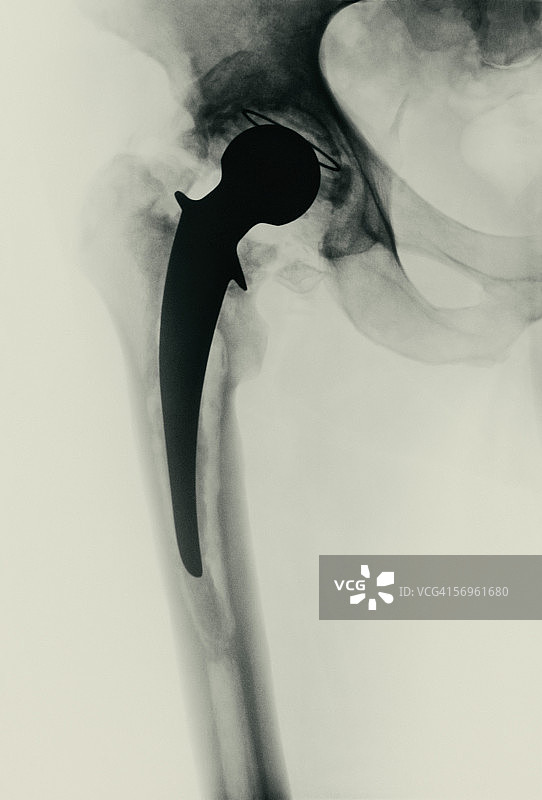 髋关节置换图片素材