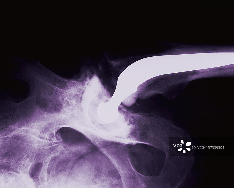 连接髋臼的股骨X光图像图片素材